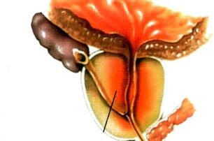 What is prostatitis in men